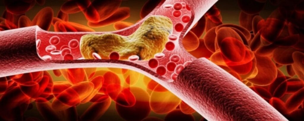 ไขมันในหลอดเลือด